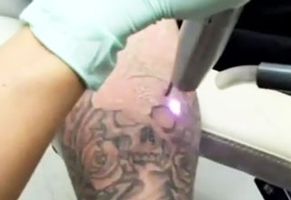 Amazing Half Sleeve Laser Tattoo Removal - Video
