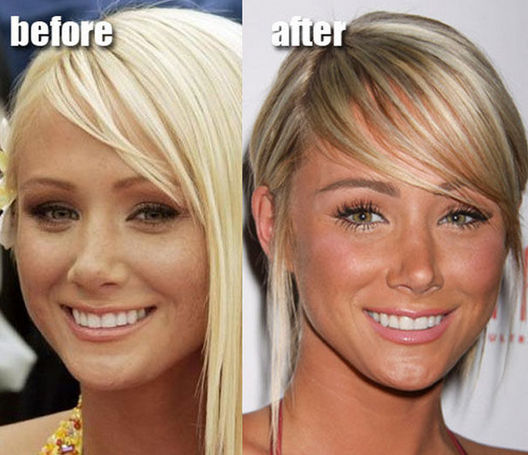 14 Celebrities Before And After Plastic Surgery Gallery Ebaum S World