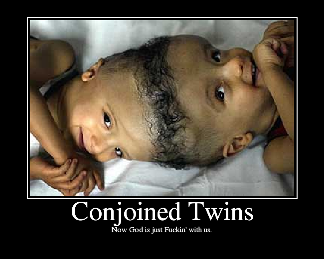 Conjoined Twins Picture Ebaum S World