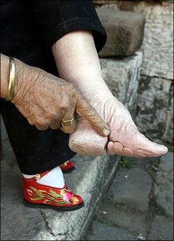 This elderly woman's feet now look like this due to years of them being bound; a tradition that has since been outlawed in her village.