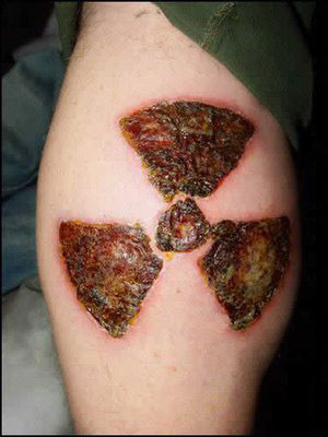 Skin Burn Tattoos