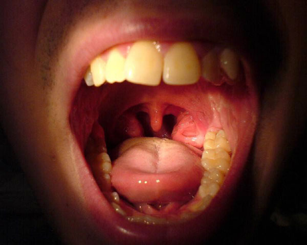 Infected Tonsils