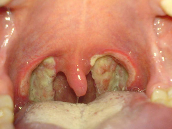 Infected Tonsils