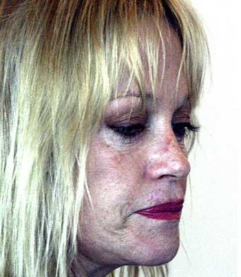 Melanie Griffith After Facelift