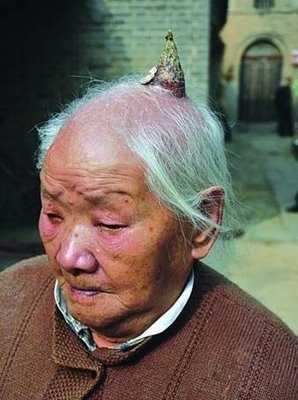 Ma Zhong Nan, a 93-year-old man living in a small village in China, recounts how a horn began to sprout on his head five years ago. 
Ma was combing his hair one day and carelessly injured his scalp. Because it was just a small wound, he did not pay much attention to it. Little did he expect that a thick, hard substance started to grow on his head.