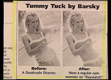 worlds worst photo shop - Tummy Tuck by Barsky Lot one unit north cd to tants Sling to Before A Quadruple Disaster. After Now a regular cast member on "Baywatch".