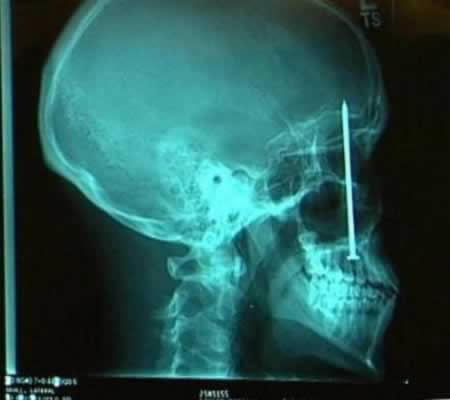 A dentist found the source of the toothache Patrick Lawler was complaining about on the roof   of his mouth: a four-inch (10-centimeter) nail the construction worker had unknowingly embedded in his skull six days earlier. 
