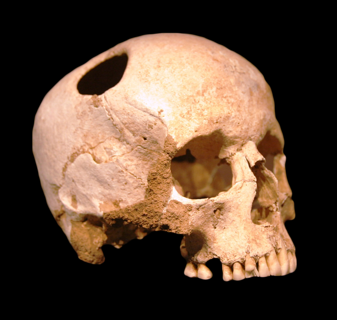 2. Trepanation - A fancy term for drilling holes in your head. This is actually the oldest surgical procedure known to man as humans have been intentionally knocking holes in their skulls dating back to the time of cavemen.