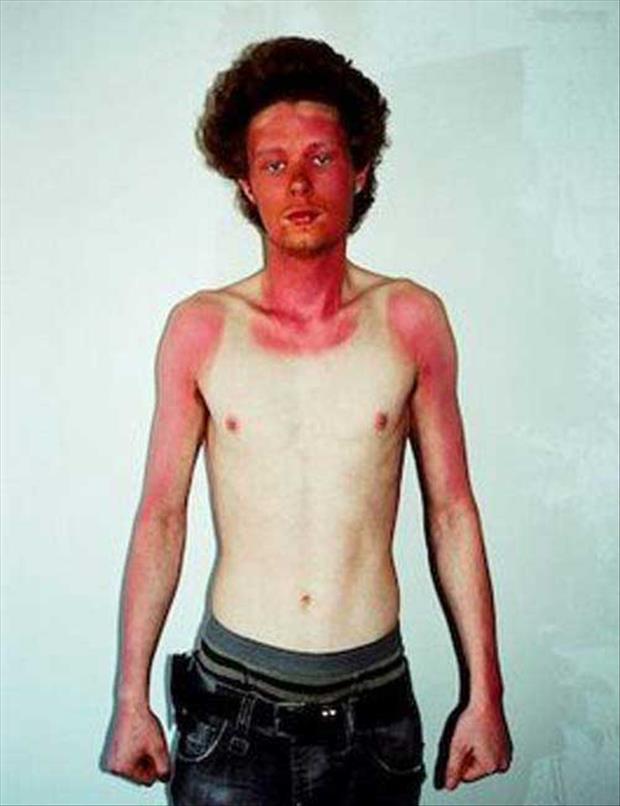 21 Insane Sunburns That Will Make You Fear the Sun
