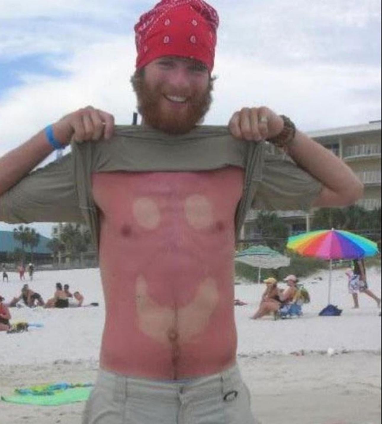 Sunburn Art is a Real Thing, and It's Glorious.