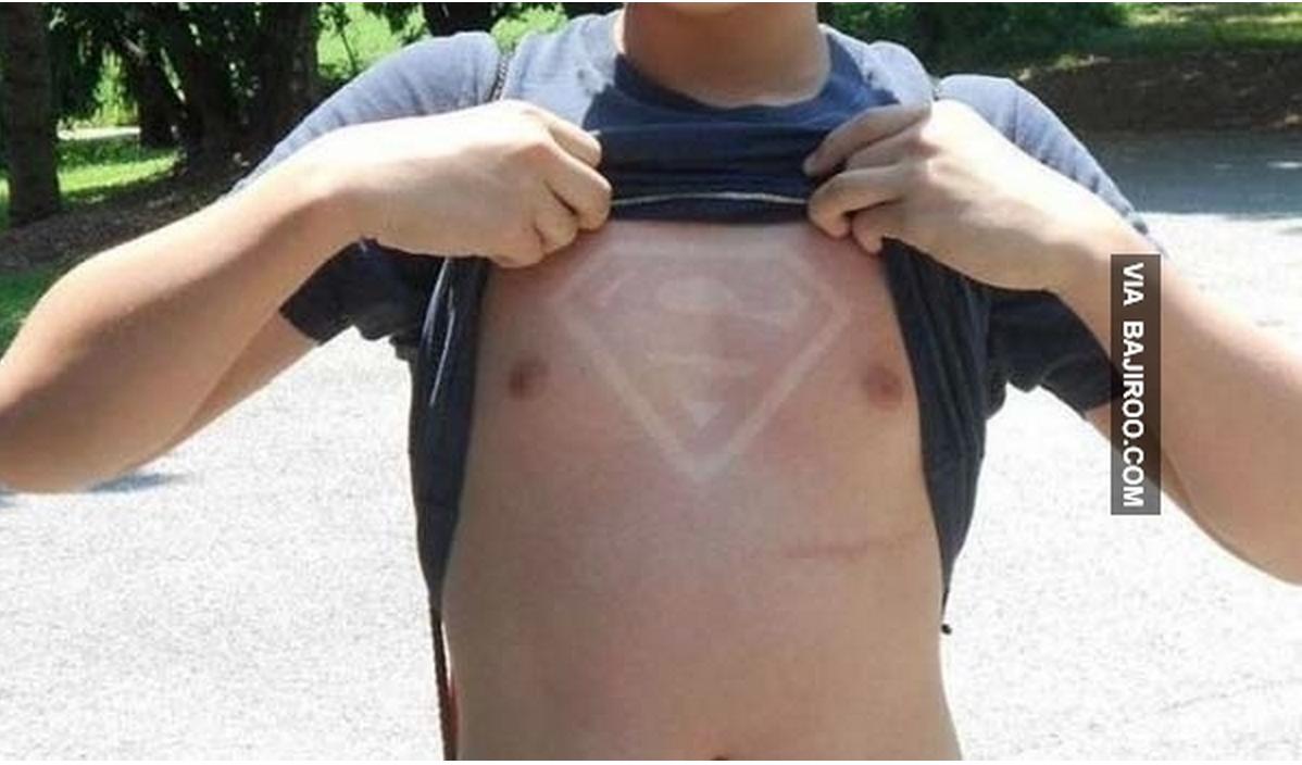 Sunburn Art is a Real Thing, and It's Glorious