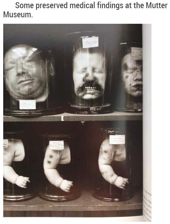 will haunt your dreams - Some preserved medical findings at the Mutter Museum