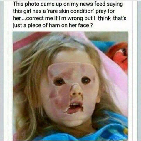 ham funny - This photo came up on my news feed saying this girl has a 'rare skin condition' pray for her....correct me if I'm wrong but I think that's just a piece of ham on her face?