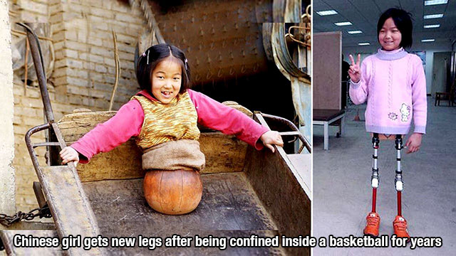 A young Chinese girl received new legs after being confined to a basketball for years.