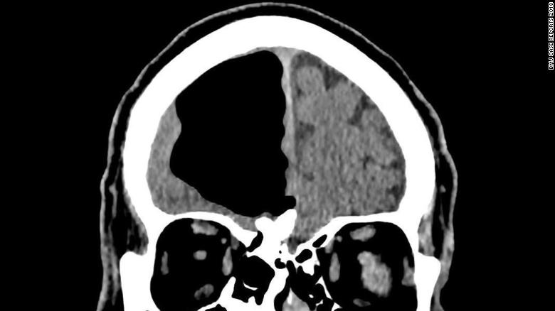 With the symptoms pertaining to just the man's left side, doctors suspected a stroke, but the scan revealed a 9 cm pocket of air in the right frontal lobe of his brain.