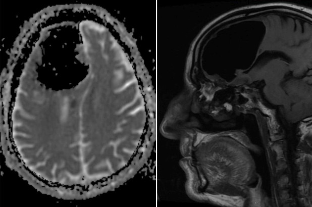 An MRI confirmed the presence of this pneumatocele (pocket of air), which probably compressed the blood vessels to the point that it cut off blood circulation to part of his brain. This likely caused a small stroke that then led to his left-sided weakness.