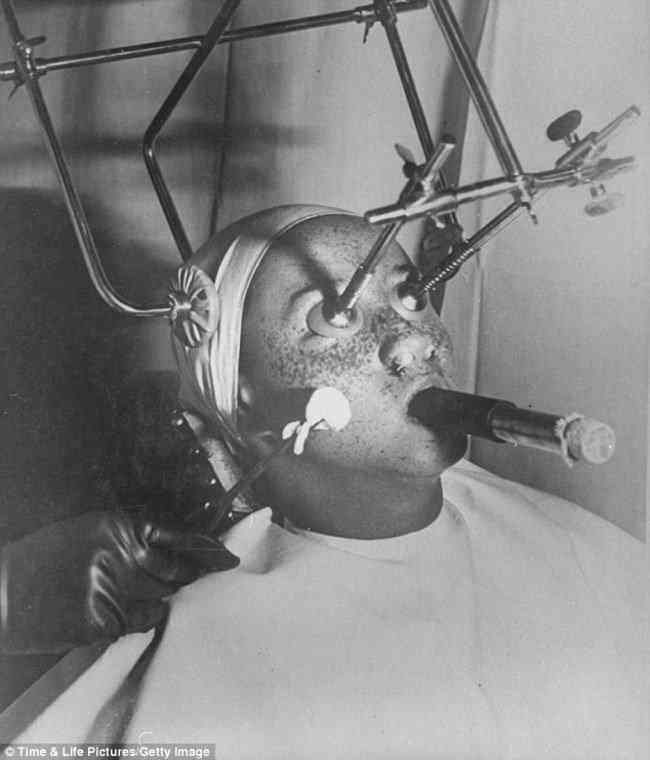 An American patient undergoes a bizarre anti-freckle treatment in 1933.