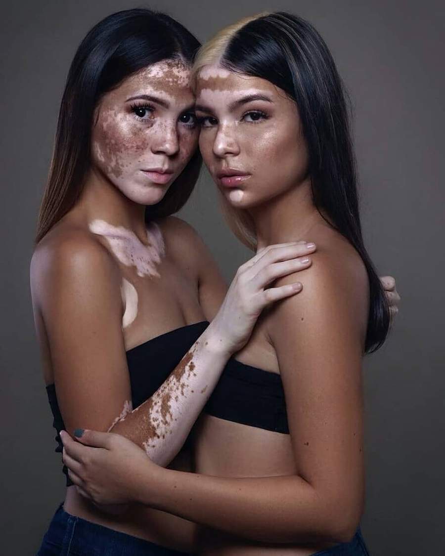 random pic models with vitiligo