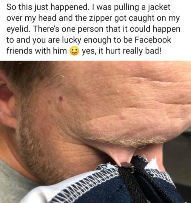 photo caption - So this just happened. I was pulling a jacket over my head and the zipper got caught on my eyelid. There's one person that it could happen to and you are lucky enough to be Facebook friends with him yes, it hurt really bad!