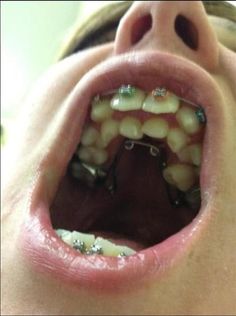 cursed - two rows of teeth