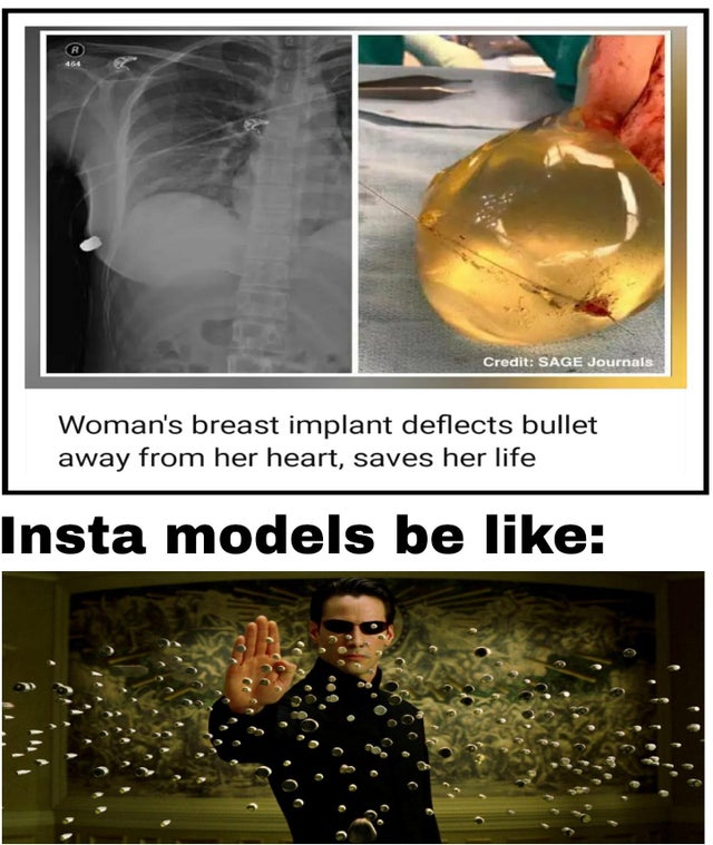 photo caption - Credit Sage Journals Woman's breast implant deflects bullet away from her heart, saves her life Insta models be