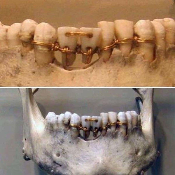 ancient egyptian dental work