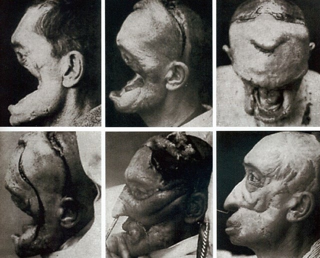 scary pictures - facial reconstruction surgery ww1