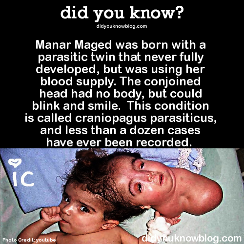 scary pictures - milky way facts - did you know? didyouknowblog.com Manar Maged was born with a parasitic twin that never fully developed, but was using her blood supply. The conjoined head had no body, but could blink and smile. This condition is called