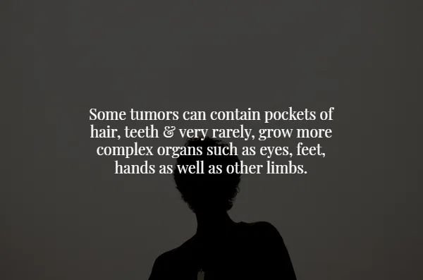 creepy facts - presentation - Some tumors can contain pockets of hair, teeth & very rarely, grow more complex organs such as eyes, feet, hands as well as other limbs.