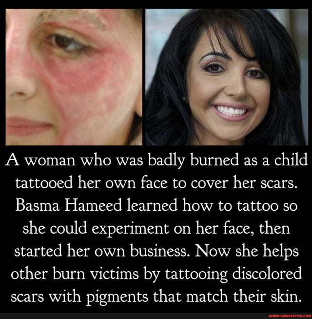 lip - A woman who was badly burned as a child tattooed her own face to cover her scars. Basma Hameed learned how to tattoo so she could experiment on her face, then started her own business. Now she helps other burn victims by tattooing discolored scars w