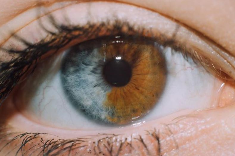 unique body features - heterochromia eyes