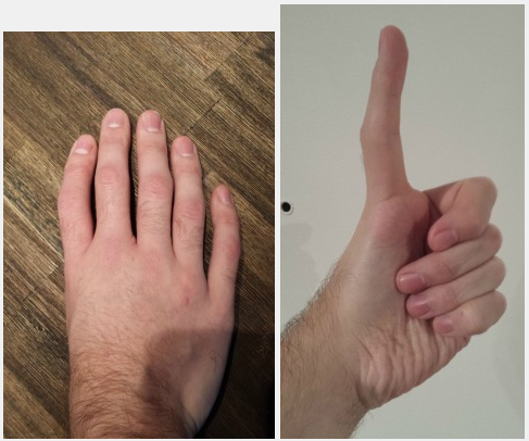 cursed pics - triphalangeal thumb