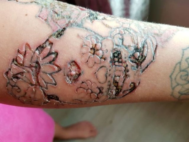 u/Megumins_AE86: <br> Infected tattoo after removal