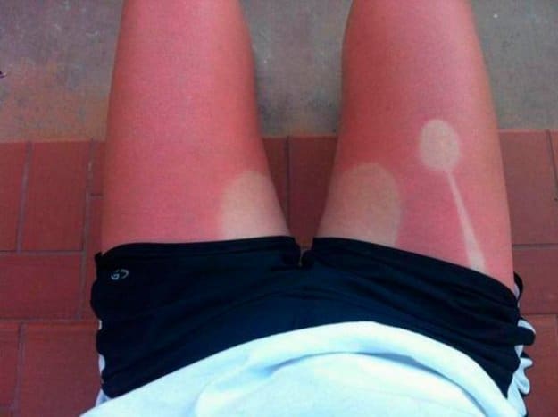 bad day - sunburn patterns