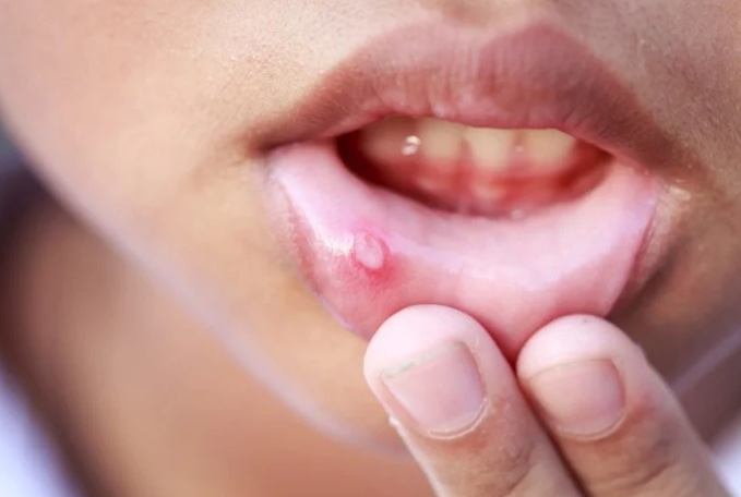 Minor Injuries That Actually Hurt - mouth ulcer