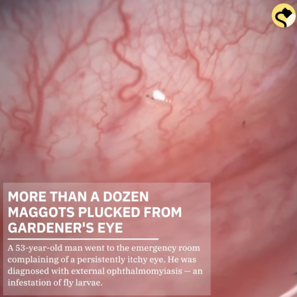 Snopes Facts - jaap van zweden - More Than A Dozen Maggots Plucked From Gardener'S Eye A 53yearold man went to the emergency room complaining of a persistently itchy eye. He was diagnosed with external ophthalmomyiasisan infestation of fly larvae.