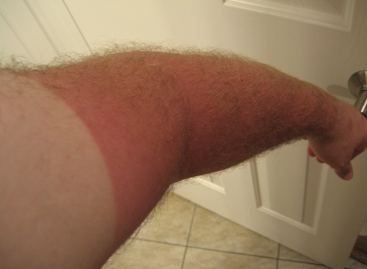 Worst Sunburns Ever - human leg