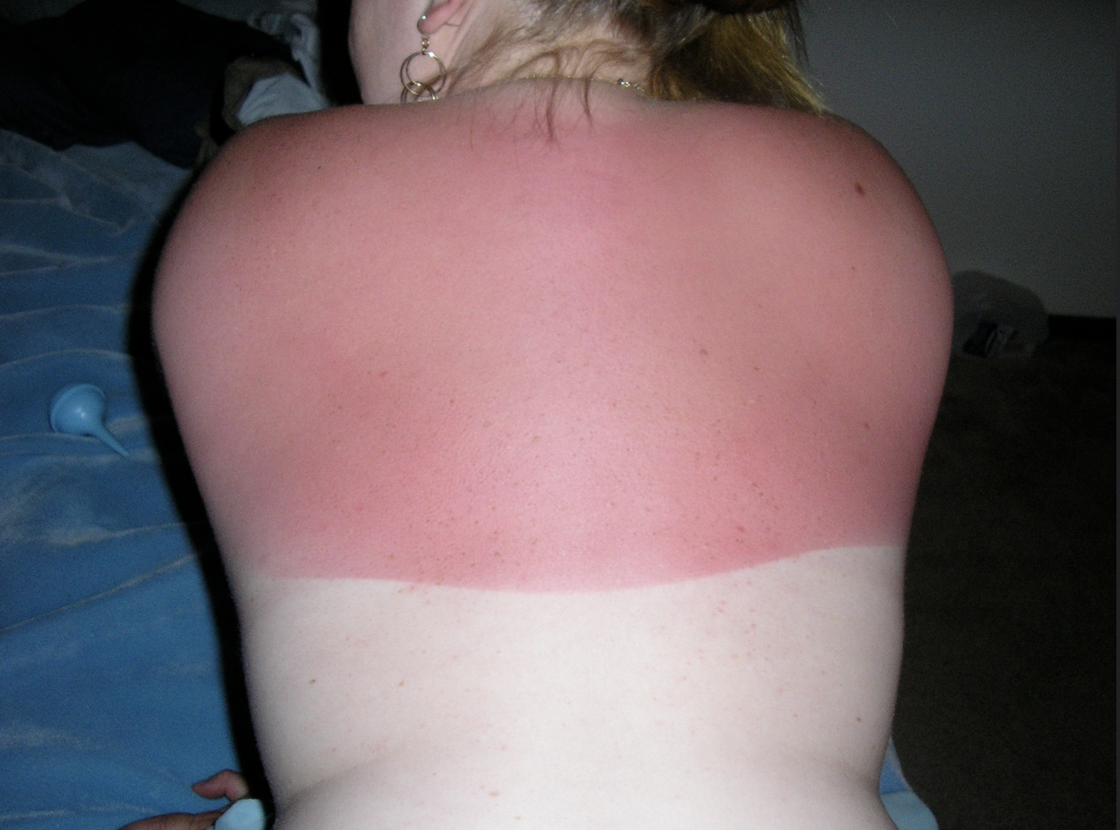 Worst Sunburns Ever - shoulder