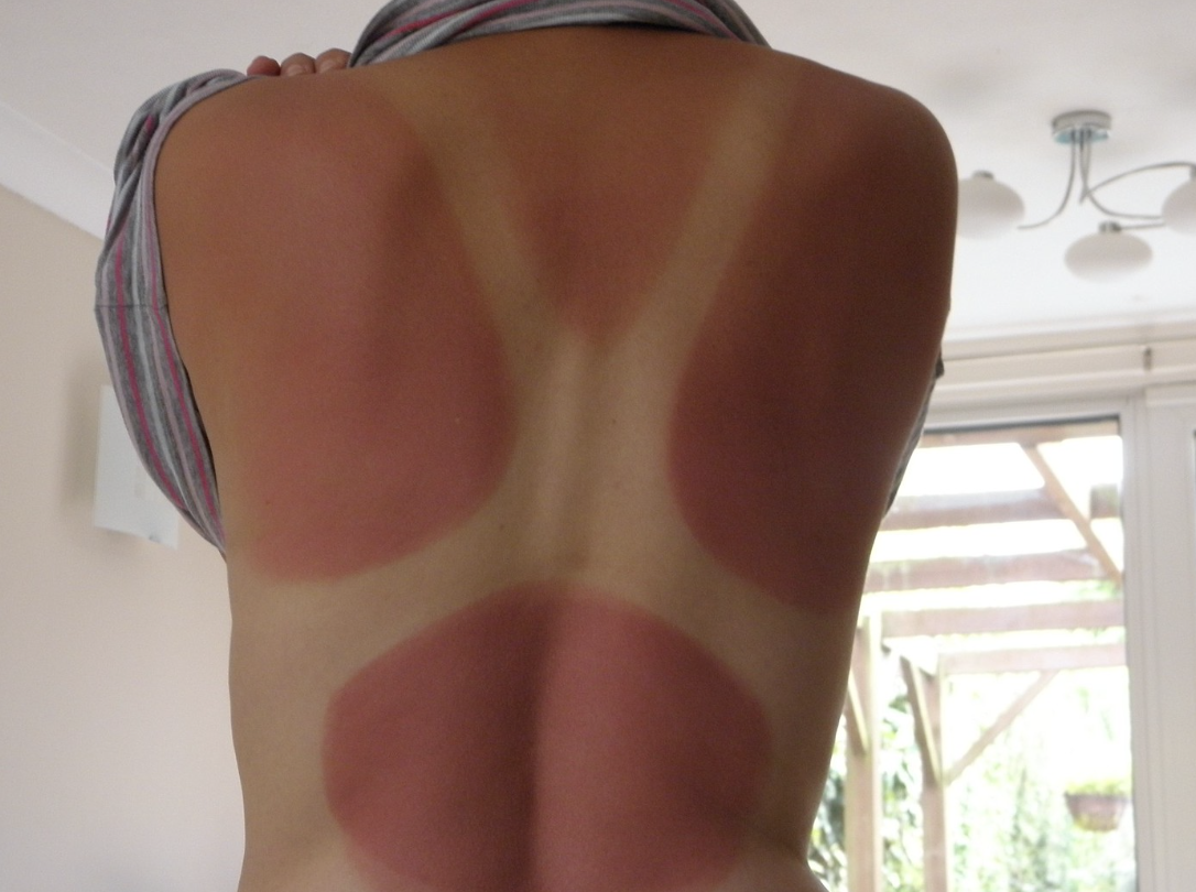 Worst Sunburns Ever - shoulder