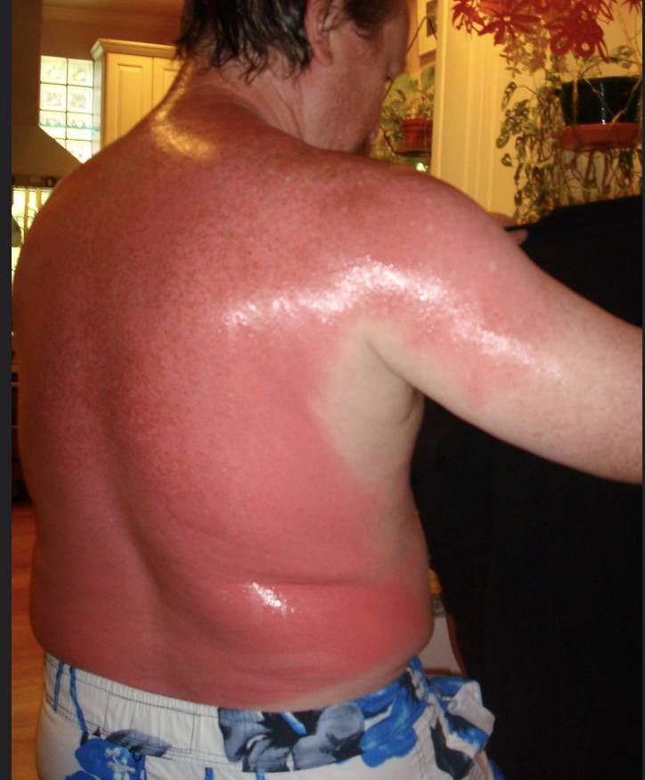 Worst Sunburns Ever - barechestedness
