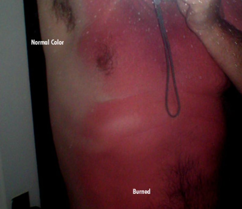 Worst Sunburns Ever - close up - Normal Color Burned