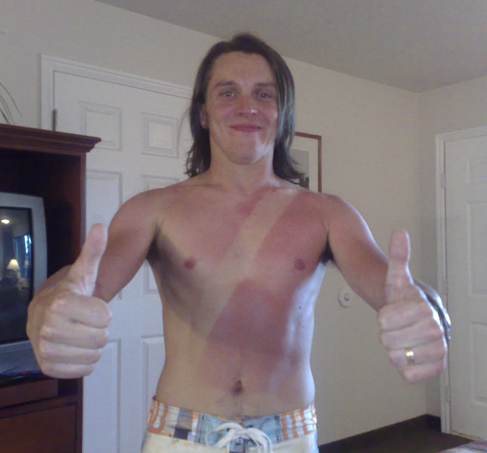 Worst Sunburns Ever - barechestedness