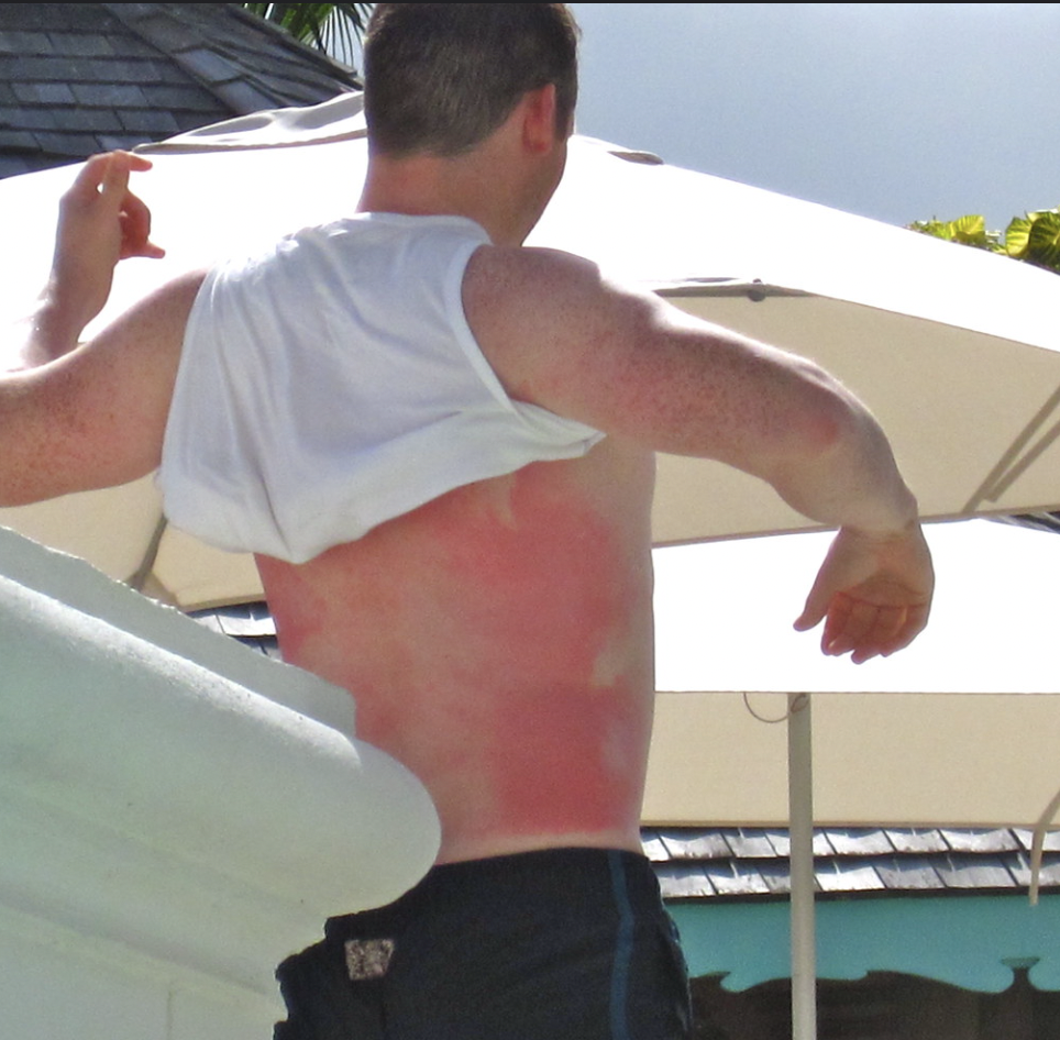 Worst Sunburns Ever - barechestedness - 2