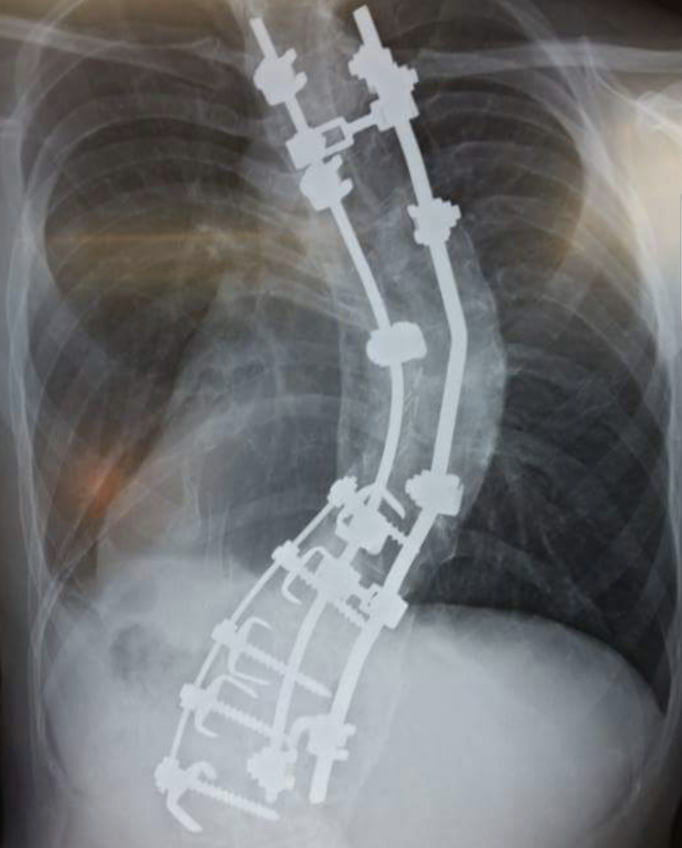 An x-ray of someone's spinal cord. I don't think it's supposed to bend like that.
