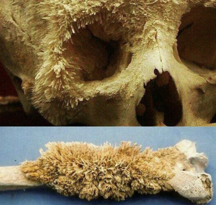 This is literally what bone cancer looks like.