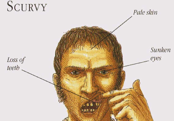 not so fun facts - pirate scurvy - Scurvy Loss of teeth Pale skin Sunken eyes