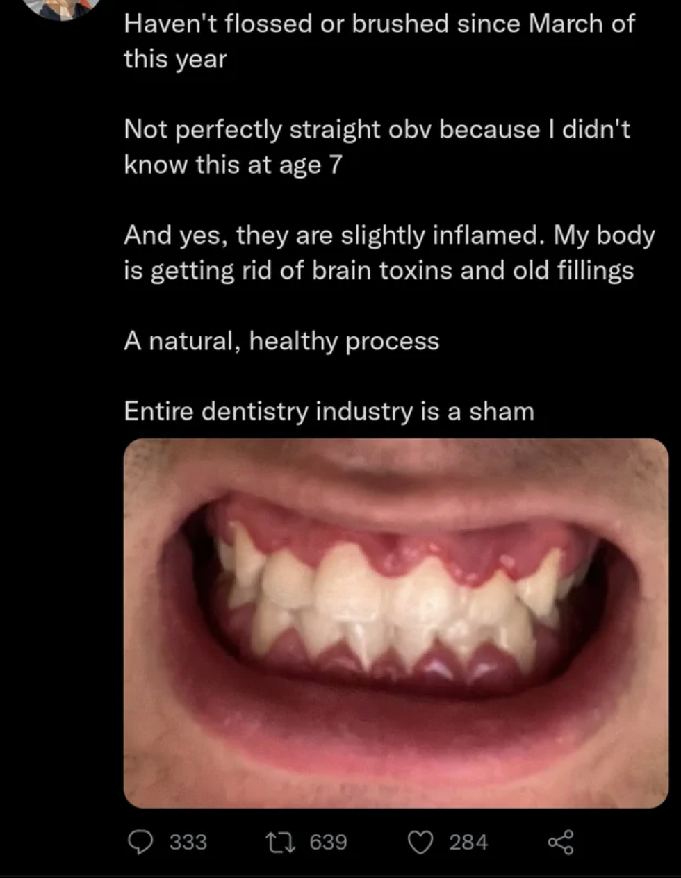 Confidently Incorrect - lip - Haven't flossed or brushed since March of this year Not perfectly straight obv because I didn't know this at age 7 And yes, they are slightly inflamed. My body is getting rid of brain toxins and old fillings A natural, health