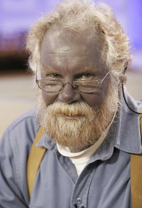 "This man, Paul Karason, had his skin turn permanently blue after spending years ingesting colloidal silver:'"