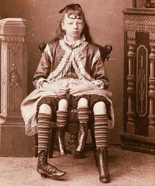 fascinating disturbing historical pics - girl with four legs - 70