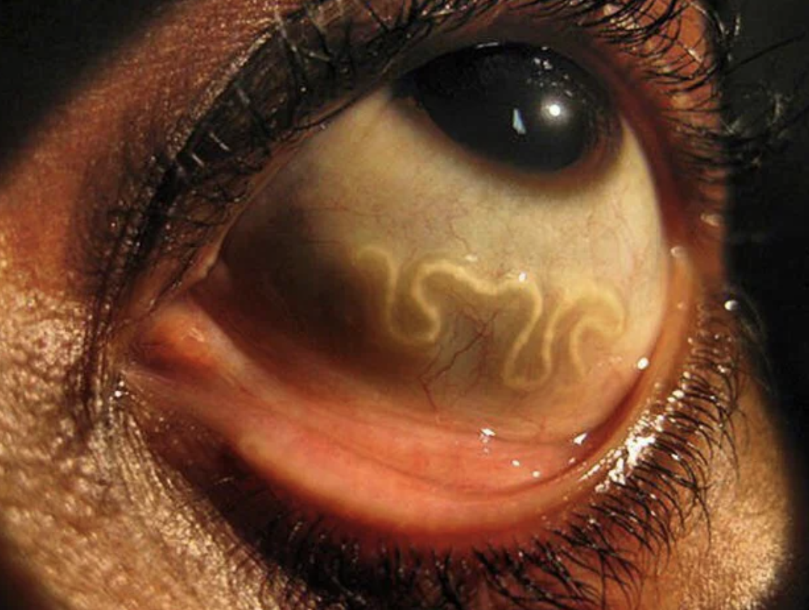 Intriguing and unsettling photos - loa loa in eye